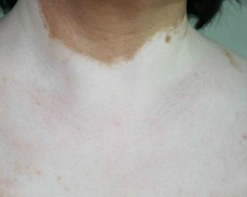 怎么治疗白巅风,女性白癜风怎么治疗效果好