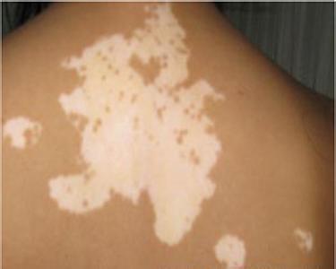 南宁市皮肤病医院,女性白癜风治疗要点有哪些