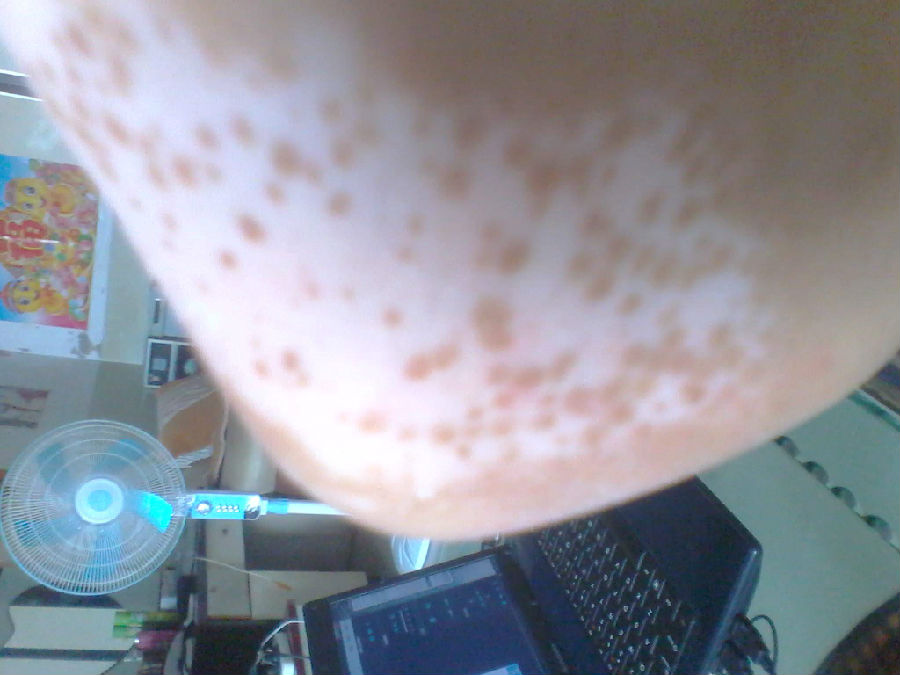 南宁皮肤医院,脚部出现白癜风患者怎么护理