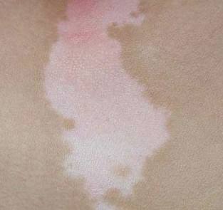 白殿疯要如何护理,面部的白癜风怎么护理比较好