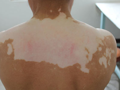 南宁白颠疯医院,老人背部的白癜风怎么治疗好呢