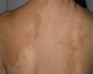 白巅风患者要吃什么,白癜风患者在平时饮食上要注意什么呢