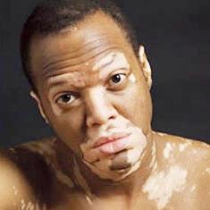 白殿疯该如何治疗,泛发型白癜风怎样治疗呢