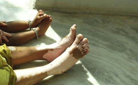 南宁白殿疯医院,肢端型白癜风有什么症状