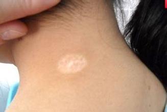 白巅风的病因有哪些,白癜风病因常见的有哪几种