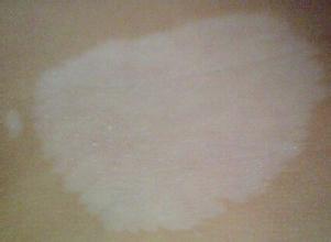 白殿疯患者的饮食,节段型白癜风病人饮食注意什么