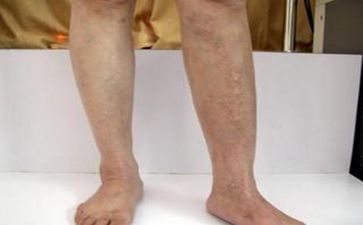 南宁西京医院在哪里,脚上有白斑需怎么饮食啊