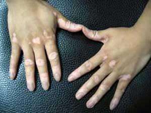 导致儿童患上白癜风的病因有什么