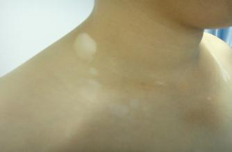 为什么男性会患白癜风呢