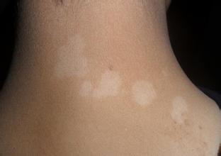 白癜风饮食要注意什么问题