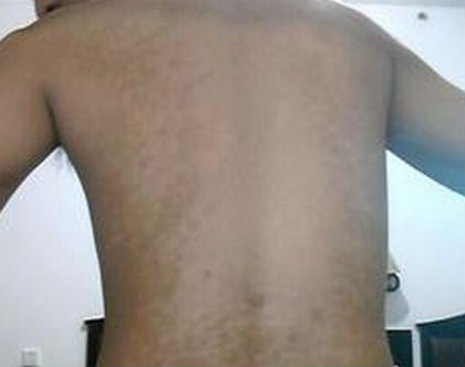 白癜风饮食注意事项,禁忌什么