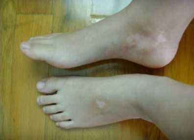 白癜风怎么治疗才有效果,怎么护理