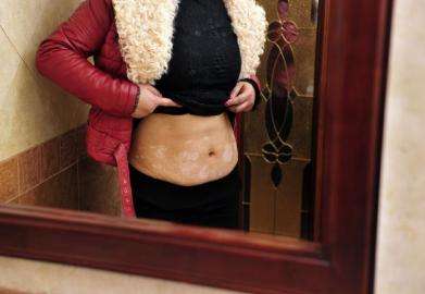 怎么预防白癜风演变成泛发型,注意什么