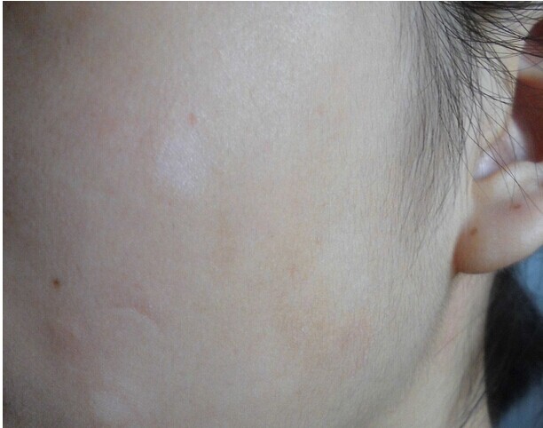 完全型白癜风发生的原因,怎么避免