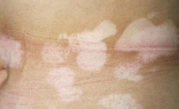 哪些药物适合白癜风的治疗,会有不良反应吗