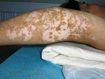 脚部白癜风是怎么出现的,病因有哪些