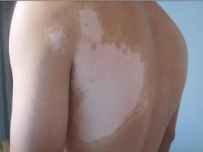 成人怎样会得白癜风,有哪些治疗方法