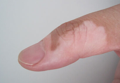 治疗白癜风的药物有哪些,如何科学治疗白癜风