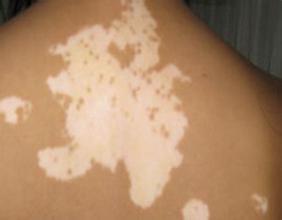 白癜风用什么偏方可以好,偏方有用吗