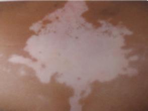 ¿É°Ñ¼Ò³¤¼±»µÁË!ºÎÖÖÔÒòÓÕ·¢¶ùͯ°×ñ°·ç