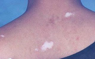 ÕâÑùÏÂÈ¥¿É²»ÐÐ!½Ú¶ÎÐͰ×ñ°·çÒªÔõôÖÎ