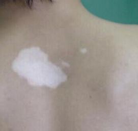 可别搞错了哦!小孩该怎么诊断白癜风呢