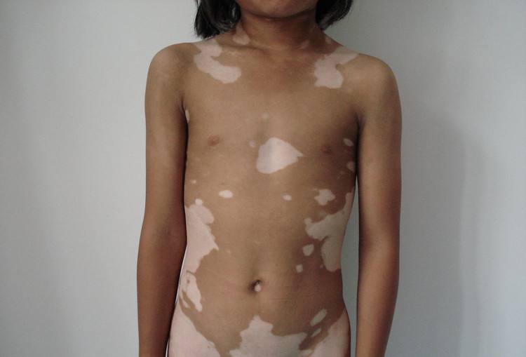 白斑又长出来了?为什么男性白癜风会复发