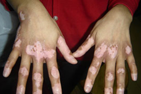 嘴馋招惹麻烦,白癜风患者吃零食的危害