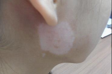 简直可怕!成人脸上长白斑怎么办比较好