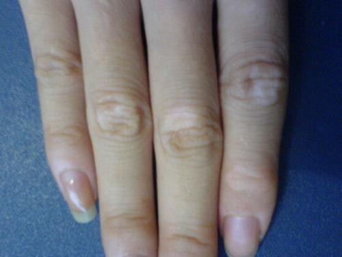 事不过三,男性如何防止白癜风的复发