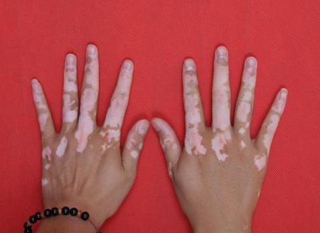 生活中哪些因素可以诱发白癜风