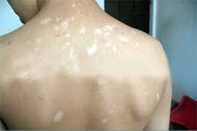 成人白癜风护理