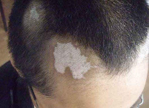 家长在儿童患了白癜风之后该怎么办