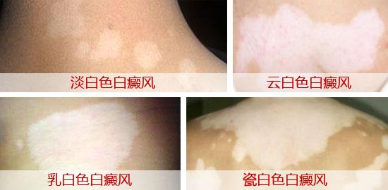 什么季节治白癜风比较好