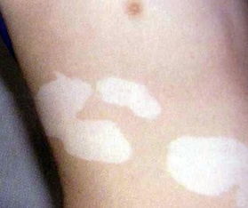 南宁如何治疗白癜风