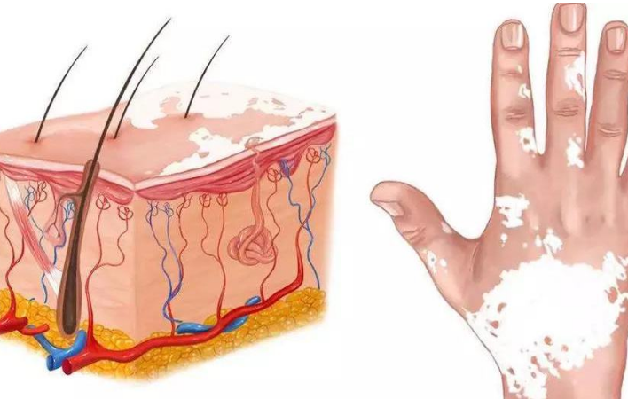 正常情况下白癜风早期是什么症状