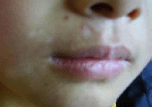 有贫血痣的白癜风儿童怎么治疗