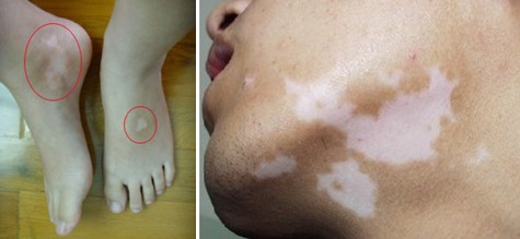 女性患了白癜风应该怎么调节心理