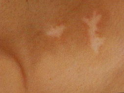 患了手部白癜风后会出现什么临床症状