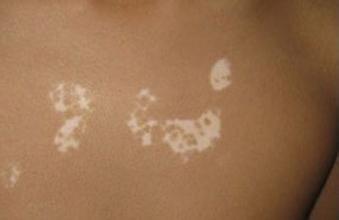 白癜风难以治疗原因