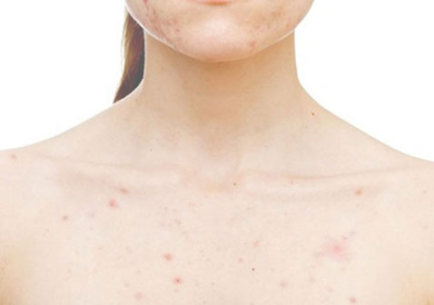 得了局限型白癜风怎么来调理