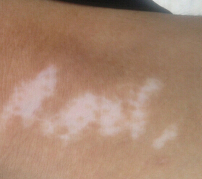 白癜风治疗的基本原则