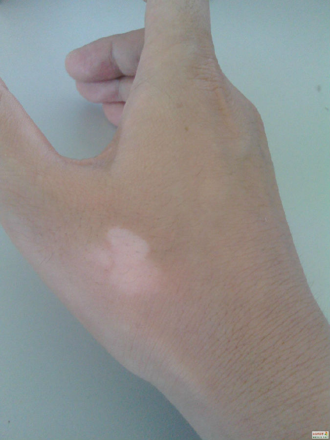 白癜风的并发症都是什么