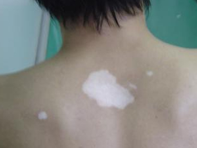 不同时期的白癜风该怎么治疗