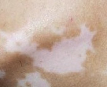 背部白癜风诊断方法有哪些