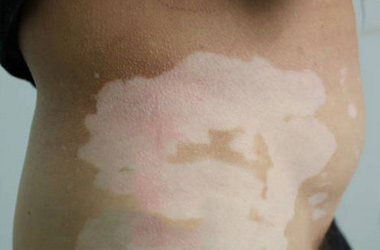 ¼òÊö·º·¢ÐͰ×ñ°·çÖ¢×´