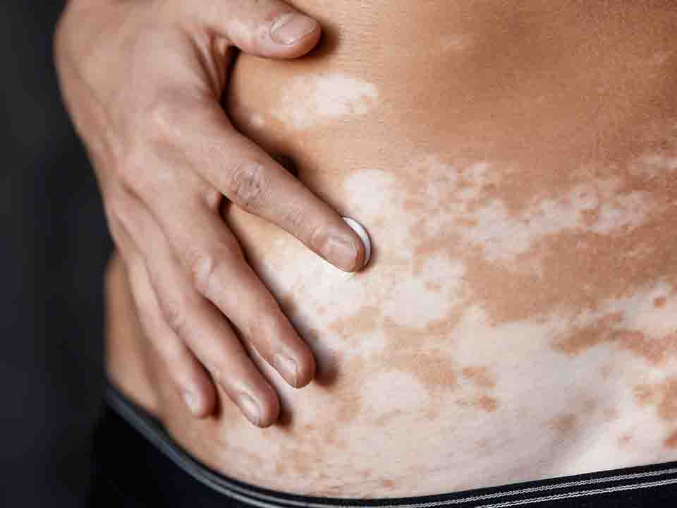 泛发型白癜风发病特点是什么