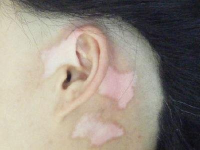 白癜风早期症状有哪些