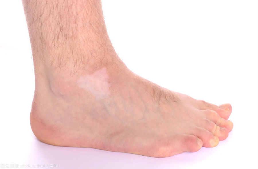 局限性白癜风患者,日常保健不容忽视