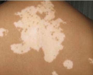 白癜风治疗过程中你踩了哪些坑